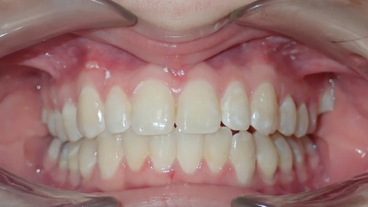 After orthodontic treatment – patient 2