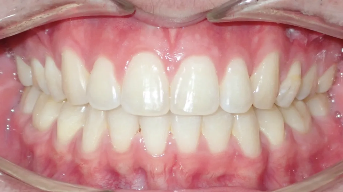 After orthodontic treatment – patient 3