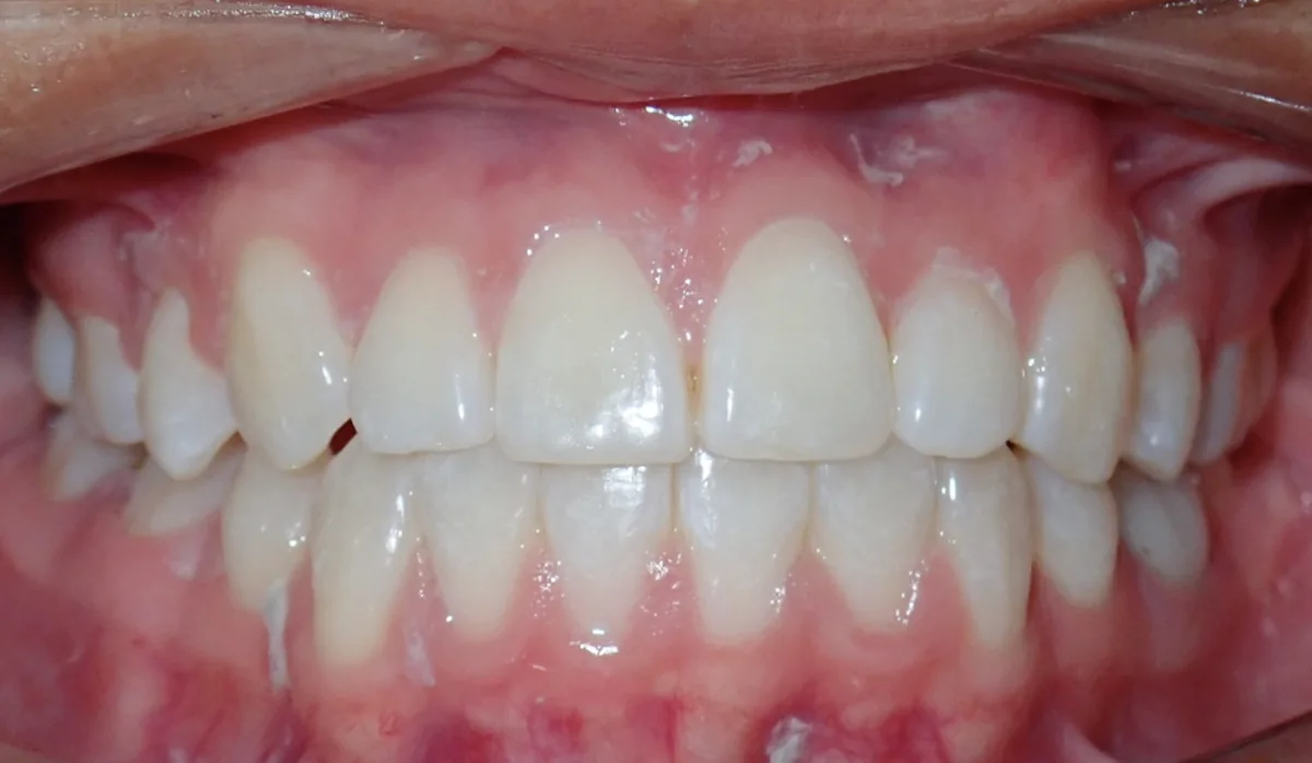 After orthodontic treatment – patient 6