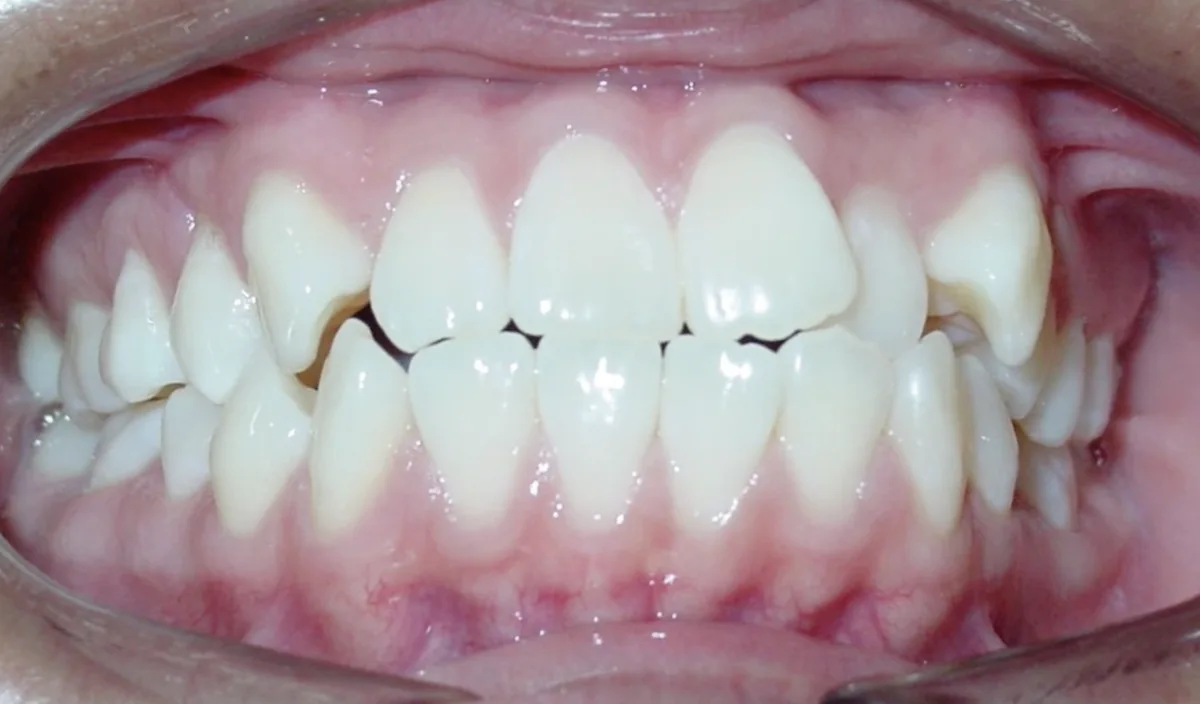 Before orthodontic treatment – patient 6